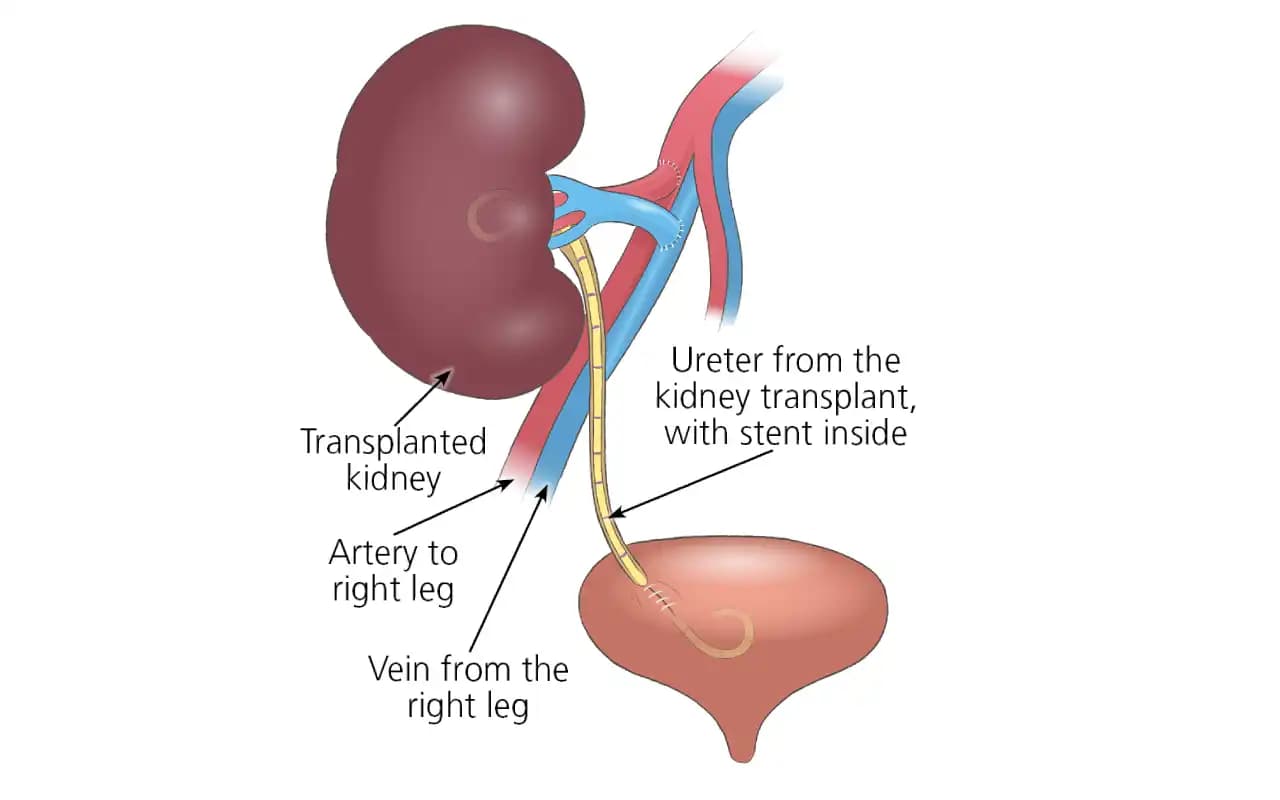 Renal Transplant