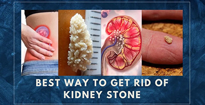 Kidney Stones and the risk that comes along with it.