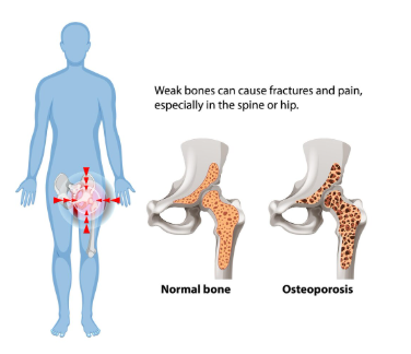Osteoporosis
