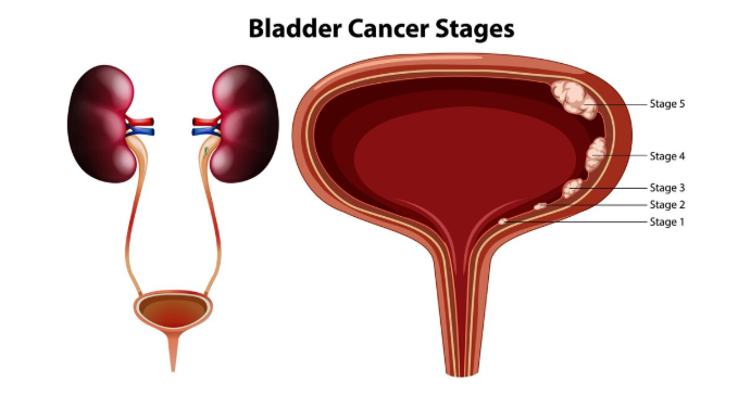 Bladder Cancer stages